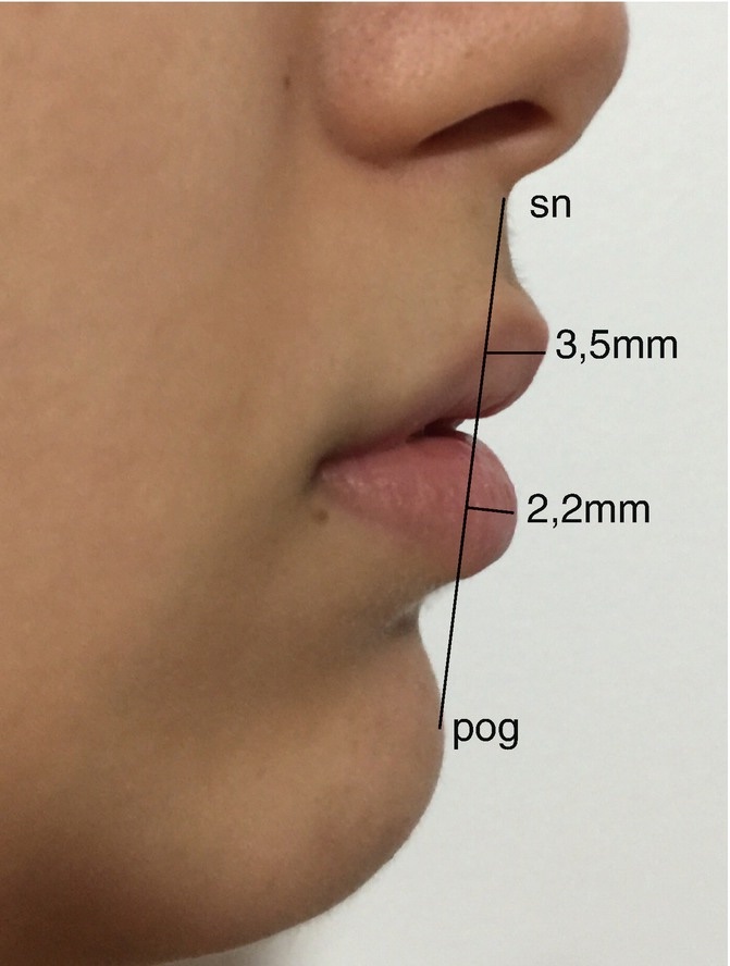 Perfiloplastia, harmonização facial