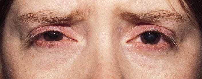 Rosácea ocular