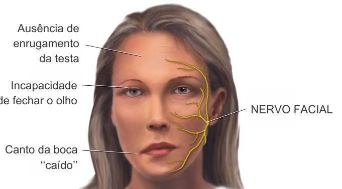 A escolha da toxina botulínica no tratamento de assimetria facial causada por paralisias